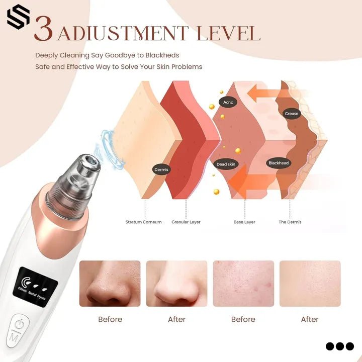 5 in 1 Blackhead Remover Vacuum Pore Cleaner – - TrendBuyPK